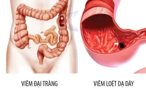 FTT_vi khuẩn HP gây hại cho đại tràng