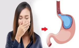 FTT_Ho do trào ngược dạ dày