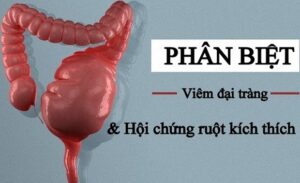 FTT_Phân biệt IBS và viêm đại tràng