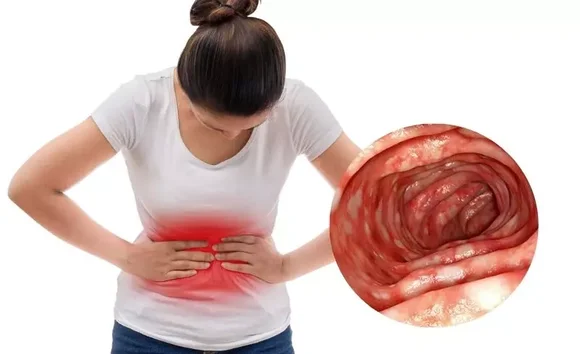 Bị sụt cân bất thường – Coi chừng vấn đề ở đại tràng! 
