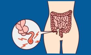 FTT_Viêm ruột thừa là gì?