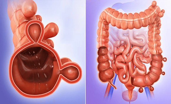 Viêm túi thừa đại tràng có nguy hiểm không? 