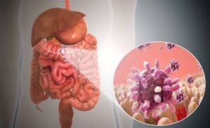 FTT_Viêm đại tràng có thể hóa ung thư sau bao lâu?