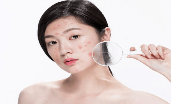 Mụn hoài không hết? Hệ tiêu hóa có thể là “Thủ phạm”