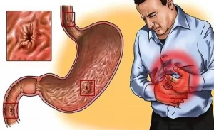 FTT_Gastritis là gì? Phân biệt viêm dạ dày cấp tính và mãn tính