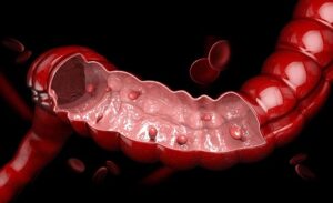 FTT_Tổng quan các loại polyp đại tràng