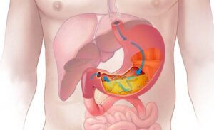 FTT_Đau dạ dày, viêm loét, trào ngược: Làm sao phân biệt?