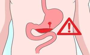 FTT_Xuất huyết dạ dày