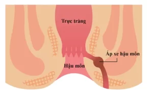 FTT_Phòng ngừa áp xe hậu môn: Những thói quen nhỏ mang lại lợi ích lớn