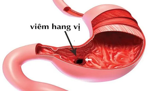 Viêm hang vị dạ dày có nguy hiểm không? Khi nào cần đi khám ngay? 