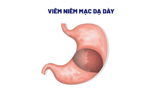 Loét niêm mạc dạ dày – Nguy hiểm thế nào nếu không điều trị sớm?