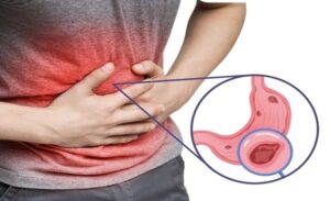 FTT_5 dấu hiệu niêm mạc dạ dày bị tổn thương và cách xử lý