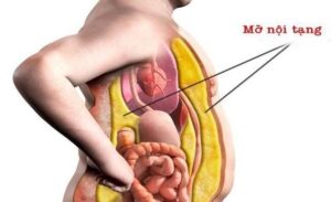 FTT_Mỡ nội tạng là gì? Hiểm họa sức khỏe ẩn sau vòng eo