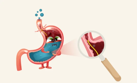 Giảm acid dịch vị: vì sao gây đầy bụng, khó tiêu và cách khắc phục 