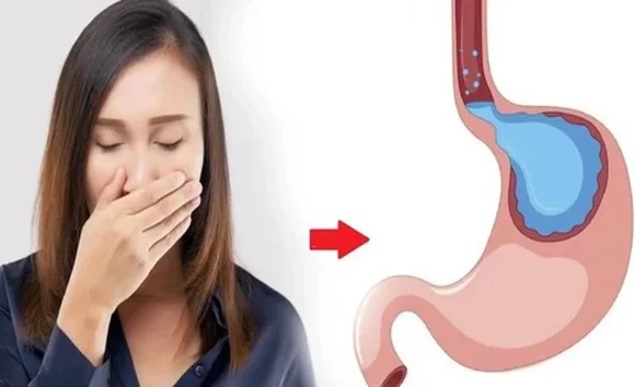 Nguyên nhân gây ợ chua, ợ hơi, nóng rát thượng vị và giải pháp hiệu quả 