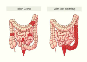 Bệnh crohn có thể kéo dài từng đợt và gây biến chứng năng